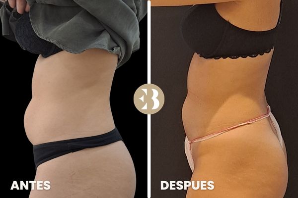 antes y después criolipolisis abdomen