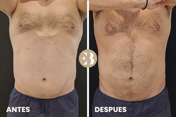 antes y después criolipolisis abdomen