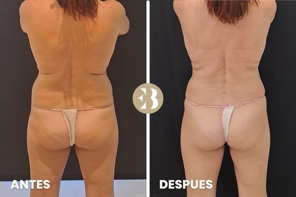 antes y despues espalda coolsculpting