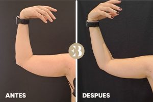 antes y después coolsculpting brazos