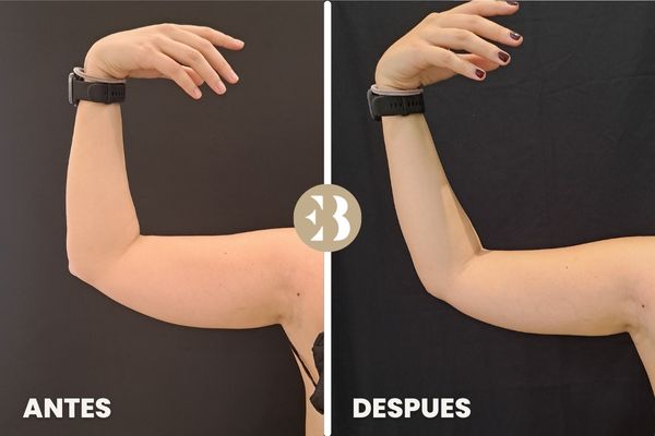 antes y después coolsculpting brazos