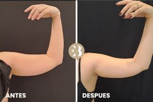 antes y después criolipolisis brazos