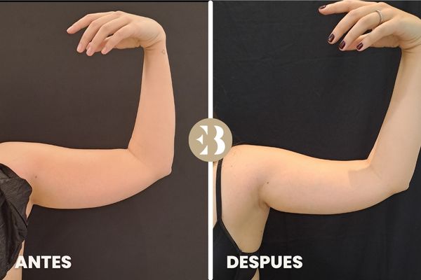 antes y después criolipolisis brazos
