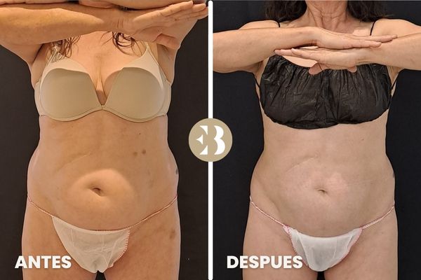 antes y después criolipolisis abdomen