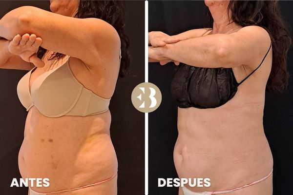 antes y después criolipolisis abdomen
