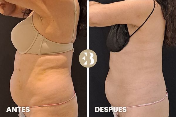 antes y después criolipolisis cintura