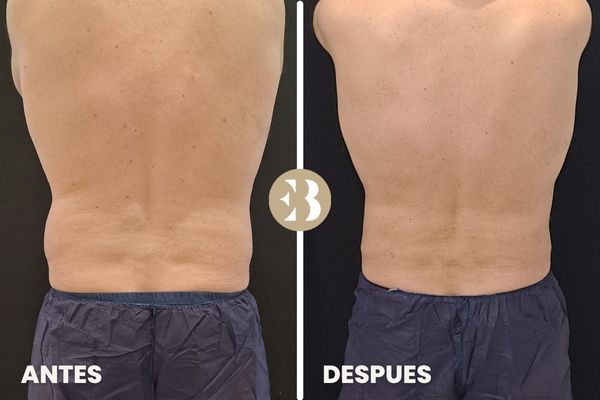 antes y despues espalda criolipolisis