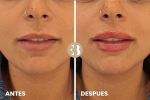 Labios Rusos Antes y Después del tratamiento en la clínica de medicina estetica EB
