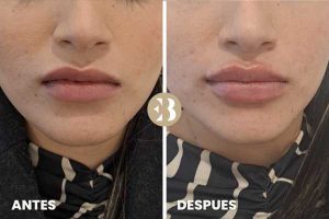 Labios Rusos Antes y Después Labios Rusos Antes y Después en la clínica de medicina estetica EB