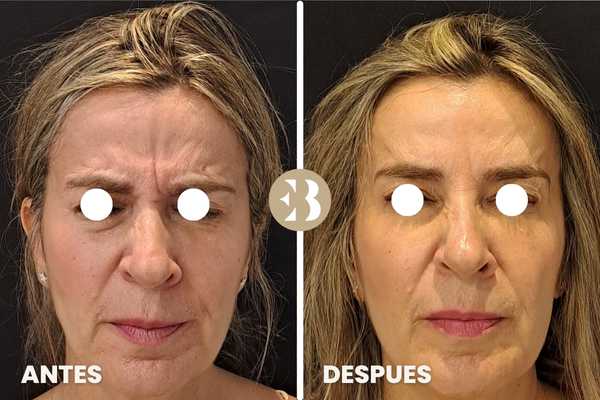 Antes y Despùes del tratamiento para quitar las arrugas en Entrecejo con Neuromodulador, Toxina Botulínica, Botox