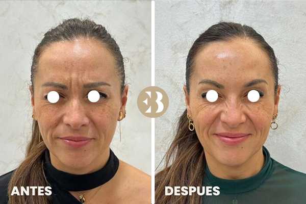 Antes y Despùes tratamiento de eliminar arrugas en Entrecejo con Neuromodulador, Toxina Botulínica, Botox