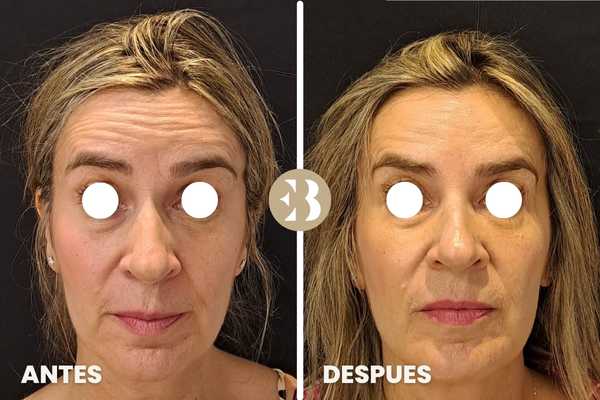 Antes y Después tratamiento quitar arrugas en frente con Neuromodulador, Toxina Botulínica, Botox