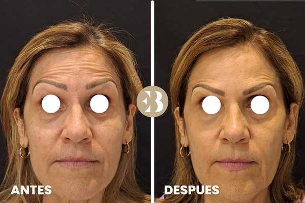 Antes y Después tratamiento eliminar arrugas en frente con Neuromodulador, Toxina Botulínica, Botox