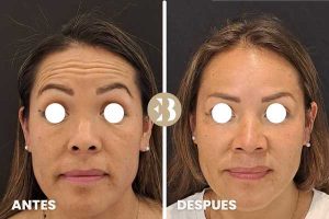 Antes y Despùes tratamiento de arrugas en frente con Neuromodulador, Toxina Botulínica, Botox