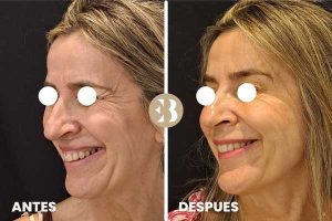 Antes y Después tratamiento para eliminar arrugas en patas de gallo con Neuromodulador, Toxina Botulínica, Botox