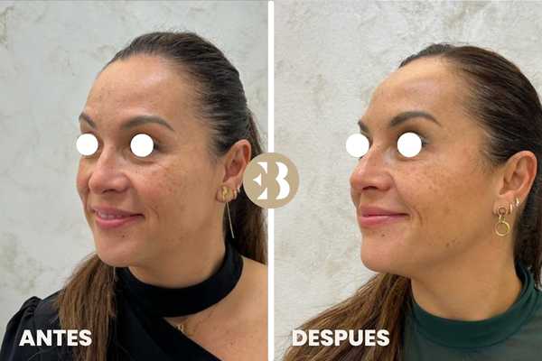 Antes y Después tratamiento de arrugas en patas de gallo con Neuromodulador, Toxina Botulínica, Botox