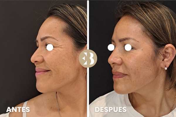 Antes y Después tratamiento de arrugas en patas de gallo con Neuromodulador, Toxina Botulínica, Botox