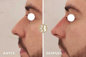 Antes y después tratamiento rinomodelacion con acido hialurónico en la clínica de medicina estetica EB
