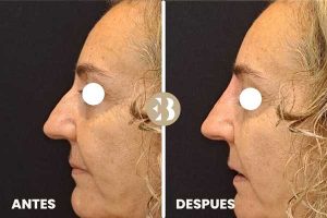 Rinomodelación Sin Cirugía Antes y después tratamiento rinomodelacion en la clínica de medicina estetica EB