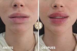 Antes y Después del tratamiento de labios Rusos en la clinica de medicina estetica EB
