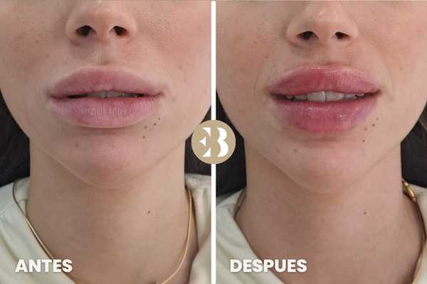 Antes y Después del tratamiento de labios Rusos en la clinica de medicina estetica EB