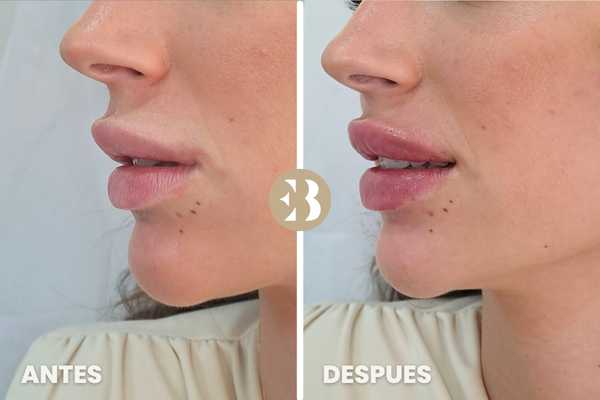 Tratamientos Labios Rusos Antes y Después Labios Rusos Antes y Después en la clínica de medicina estetica EB
