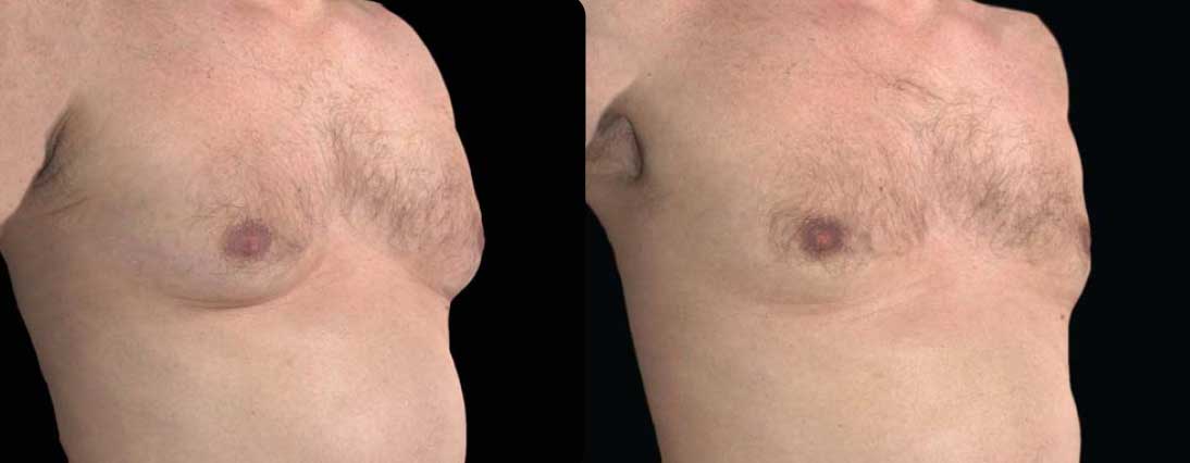 eliminar grasa pectoral