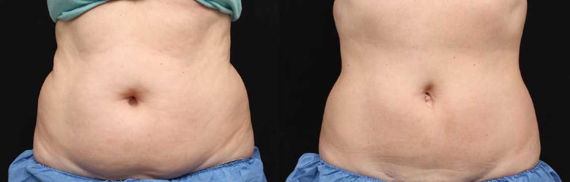 eliminar grasa abdomen