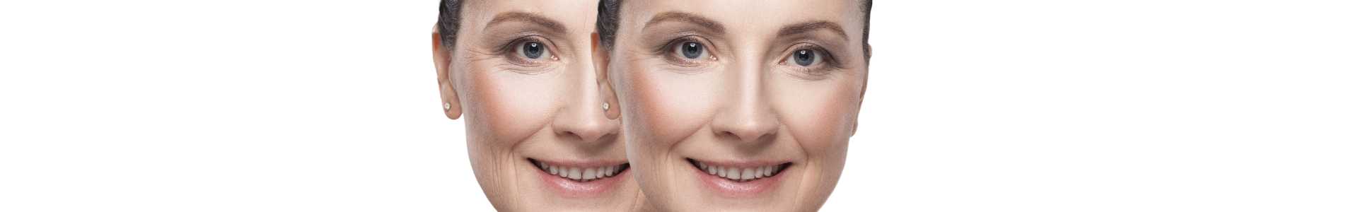 neuromoduladores tratamiento antiarrugas con toxina botulínica