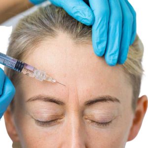 radiesse lifting facial sin cirugía radiesse lifting facial sin cirugía