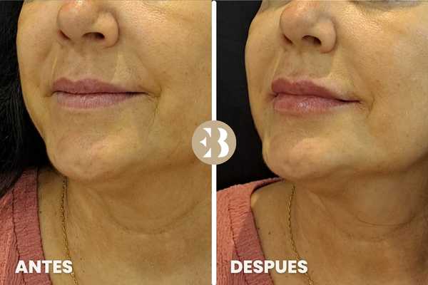 antes y después hidratación labios