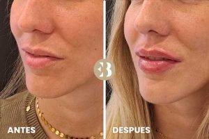 antes y después del tratamiento de incrementar el volumen labial