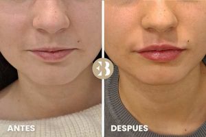 antes y después hidratación labios