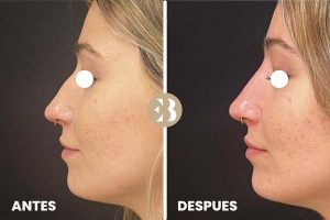 antes y después rinomodelación. Ácido Hialurónico Nariz
