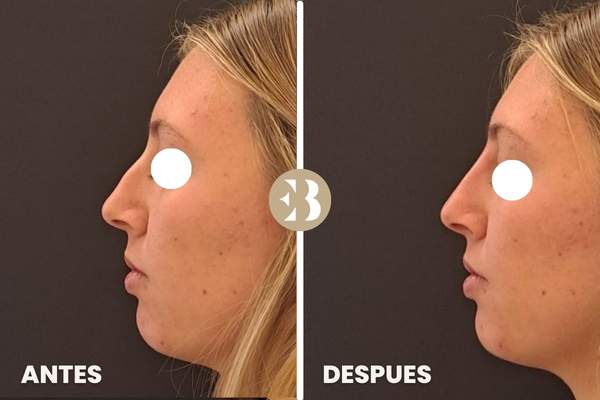 Antes y Después del tratamiento de Rinomodelación