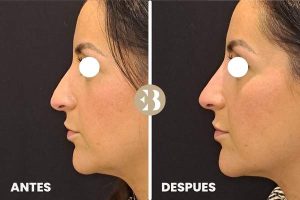 Antes y Después del tratamiento de Rinomodelación