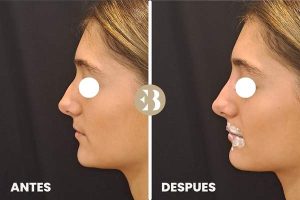 Antes y Después del tratamiento de Rinomodelación