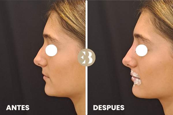 Antes y Después del tratamiento de Rinomodelación