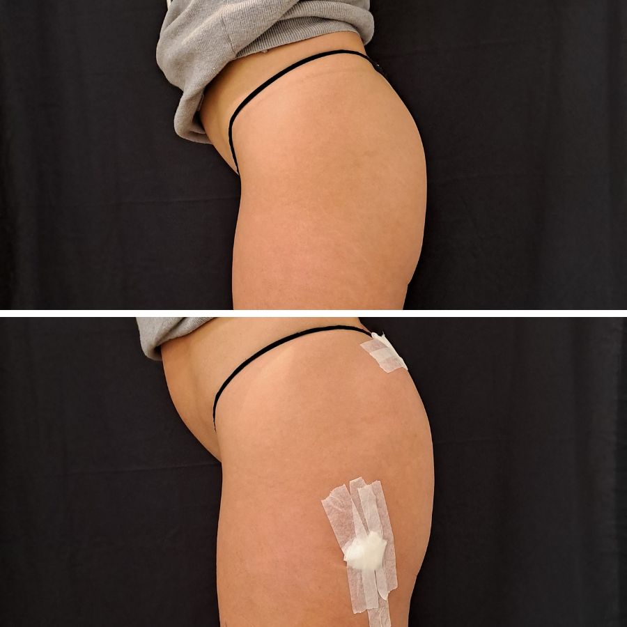 Aumento de Glúteos de Makoke en la Clínica de Medicina Estetica EB. Clínica dirigida medicamente por la Doctora Elena Berezo