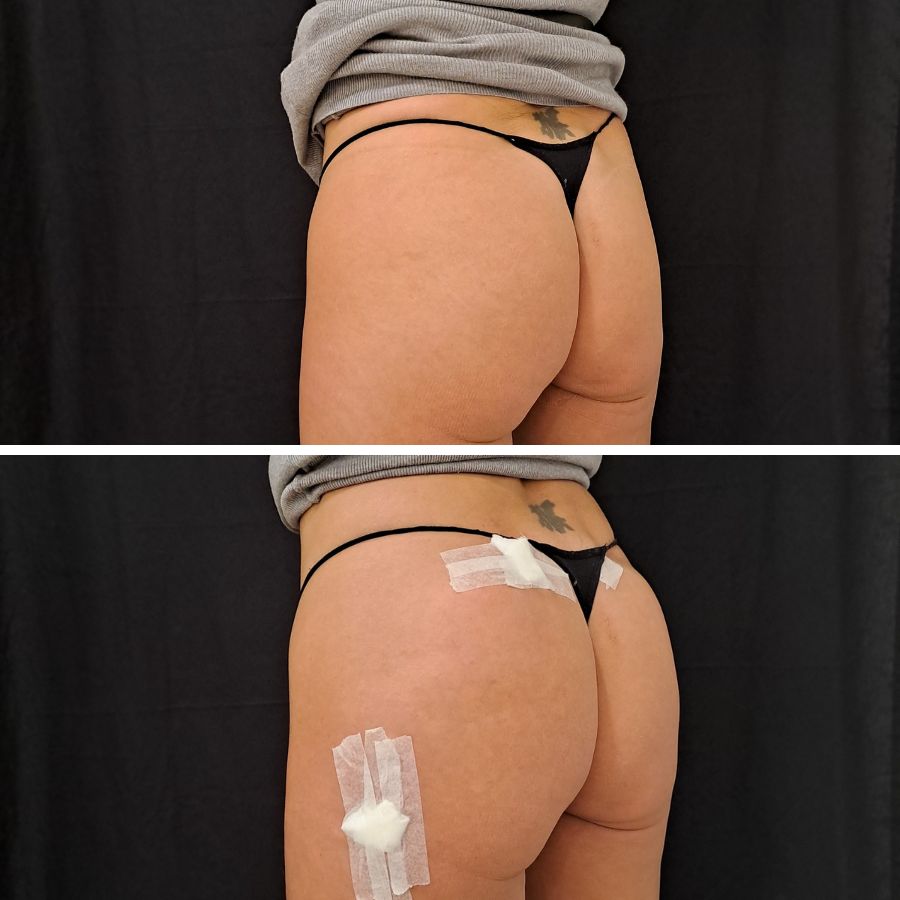 Aumento de Glúteos de Makoke en la Clínica de Medicina Estetica EB. Clínica dirigida medicamente por la Doctora Elena Berezo
