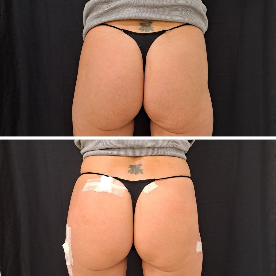 Aumento de Glúteos de Makoke en la Clínica de Medicina Estetica EB. Clínica dirigida medicamente por la Doctora Elena Berezo