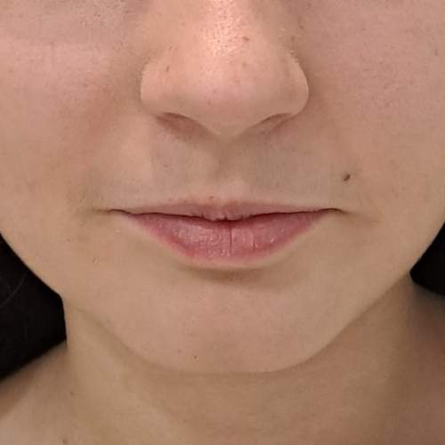 El Antes de tratamiento aumento de labios con ácido hialurónico en la clínica de medicina estetica EB en Madrid