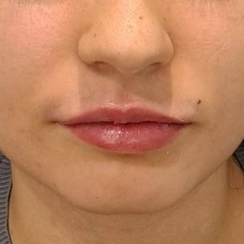 El Después de tratamiento aumento de labios con ácido hialurónico en la clínica de medicina estetica EB en Madrid