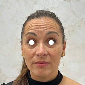 El Antes de tratamiento Eliminar arrugas frente con botox