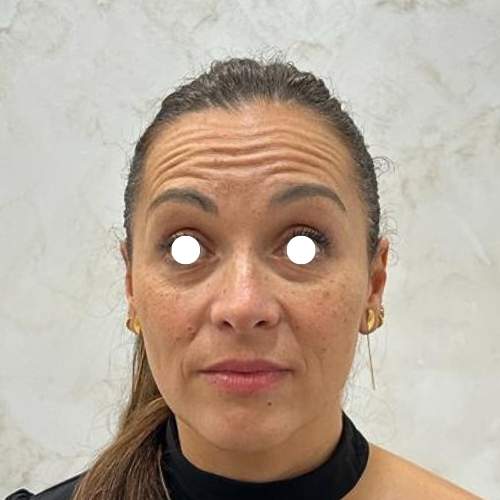 El Antes de tratamiento Eliminar arrugas frente con botox