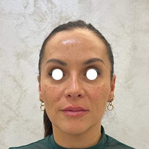 El Después de tratamiento Eliminar arrugas frente con botox