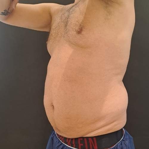 El Antes de tratamiento eliminar grasa localizada con Coolsculpting en la clínica de medicina estetica EB en Madrid