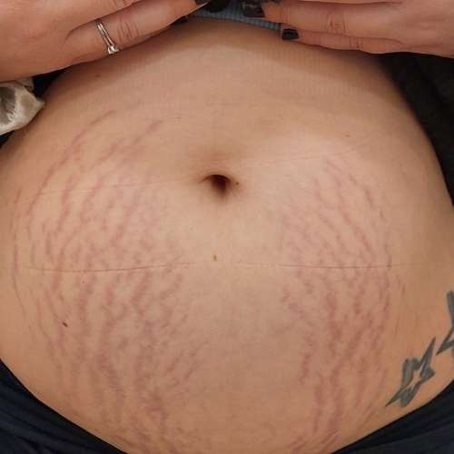 El después del Tratamiento de eliminar Acne, cicatrices o estrías en la clínica de medicina estetica EB en Madrid