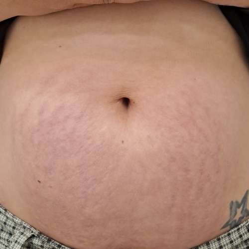 El después del Tratamiento de eliminar Acne, cicatrices o estrías en la clínica de medicina estetica EB en Madrid