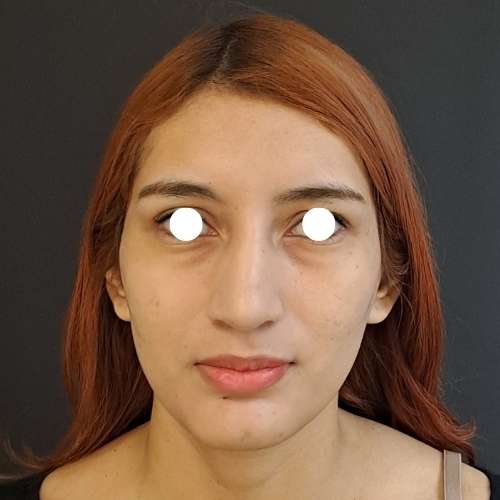 El antes del Tratamiento de Eliminar Ojeras con ácido hialurónico en la clínica de medicina estetica EB en Madrid